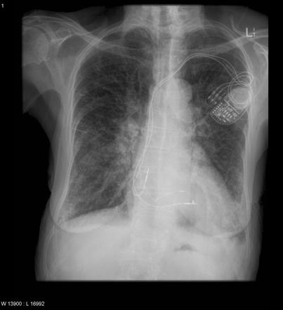 Heart failure with Kerley B lines. (Image courtesy of Radiopaedia.org)