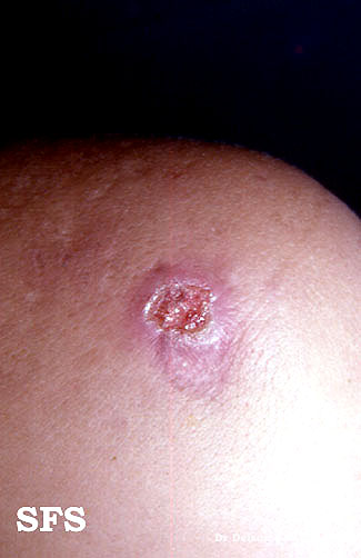 Gummatous lesions in tertiary syphilis - Adapted from Dermatology Atlas.[4]