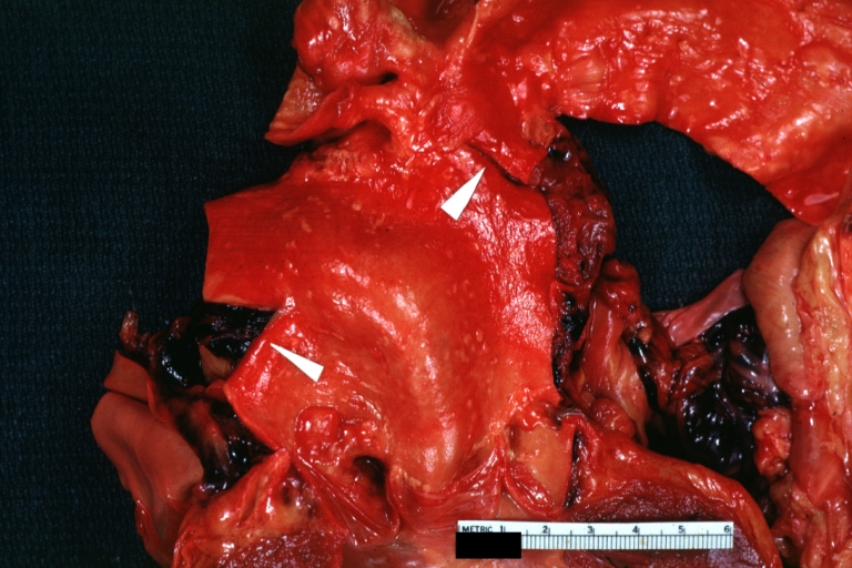 Dissecting Aneurysm: Gross, rather well shown dissection in first portion of the aortic arch