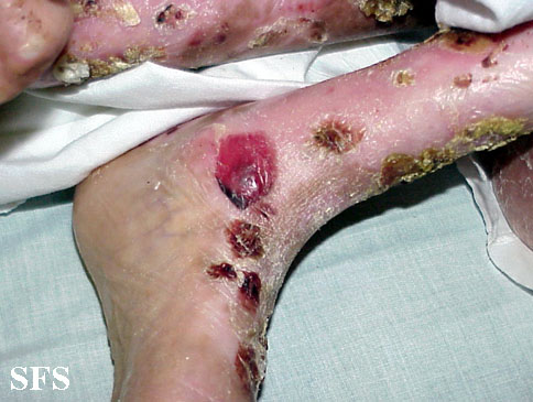 Epidermolysis bullosa dystrofic recessive. Adapted from Dermatology Atlas.[8]