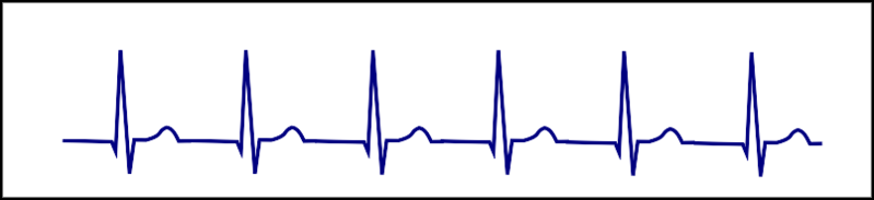 File:Junctional tachycardia.png