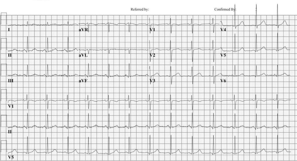 An example of a normal ECG. Click on the Image for an enlargement]]