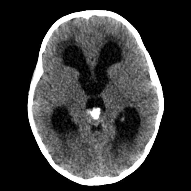 Single head CT image demonstrates a soft tissue mass in the region of the pineal gland with eccentric calcification (anterior) and evidence of hydrocephalus.[7]