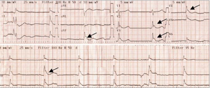 Admission EKG: Sinus bradycardia and giant Osborn wawes [12]