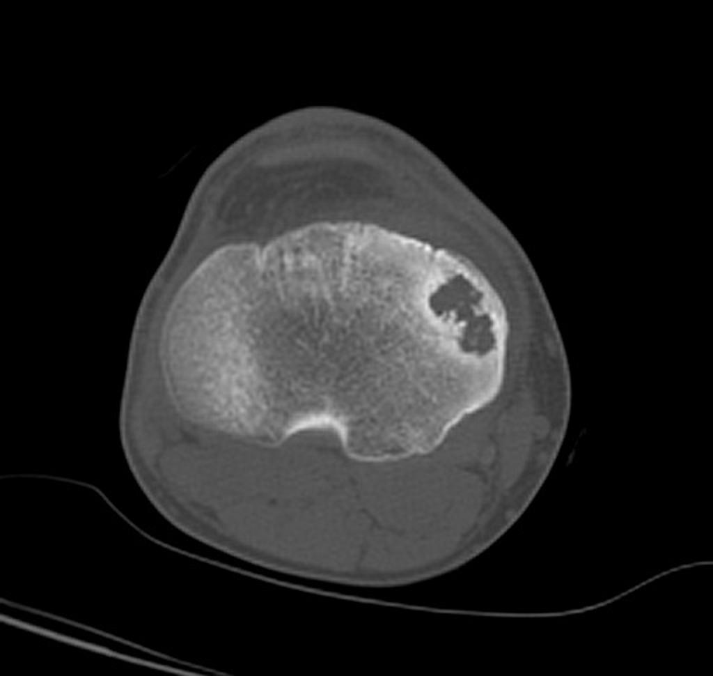 File:Chondroblastoma CT scan.jpg