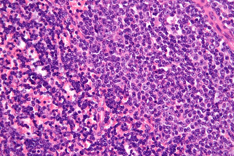 Chronic lymphocytic leukemia demonstrated on very high magnification[4]