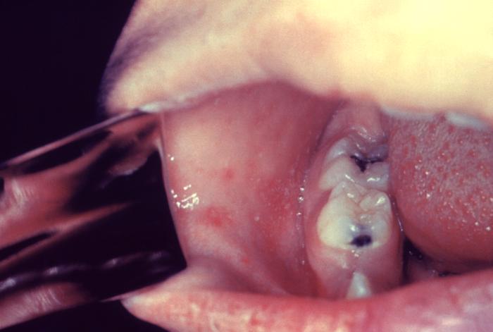 Image shows Koplik's spots opposite the base of second molars.