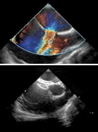 An echocardiogram of a secundum ASD with doppler flow across the defect before and after closure