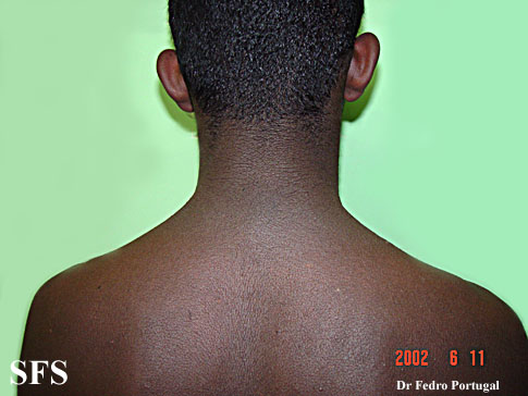 Acanthosis nigricans. Adapted from Dermatology Atlas.[2]