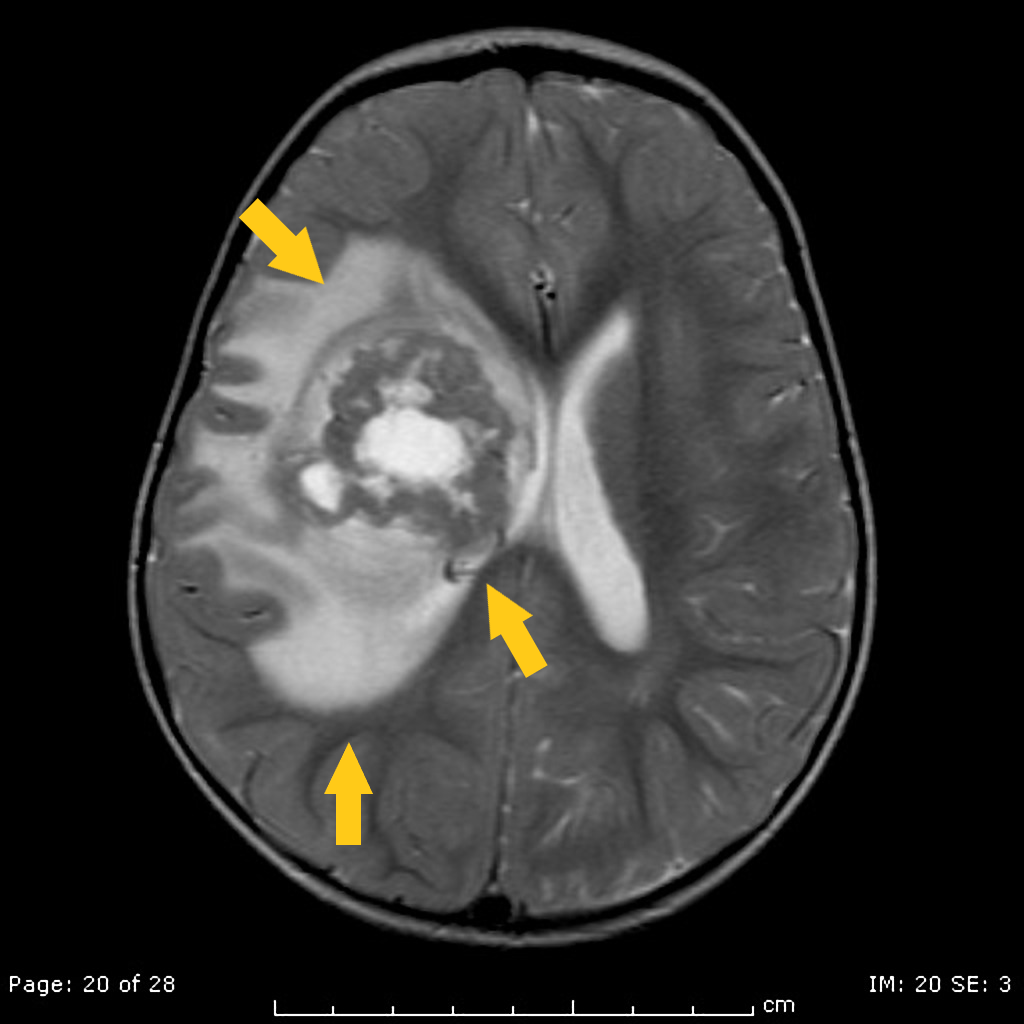 File:Atypical teratoid rhabdoid tumor MRI.png