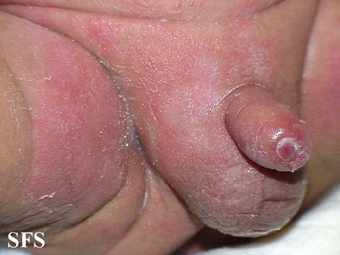 Candidiasis. Adapted from Dermatology Atlas.[4]