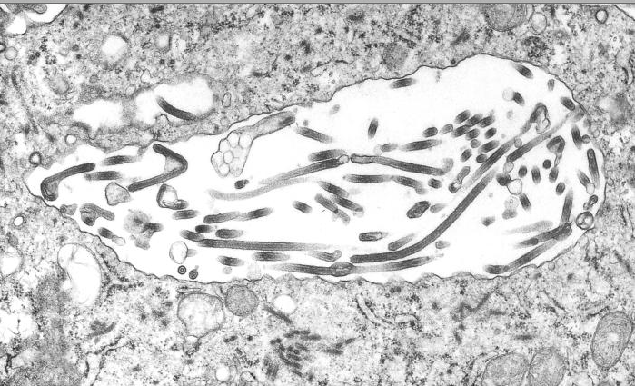 This transmission electron micrograph (TEM) demonstrates the ultrastructural morphologic changes in this tissue sample isolate. Source: CDC Adapted from Public Health Image Library (PHIL), Centers for Disease Control and Prevention.[20]