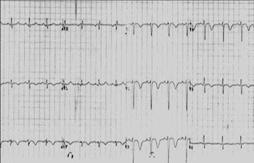 Most common ECG finding in pulmonary embolism is anterior T wave inversion.