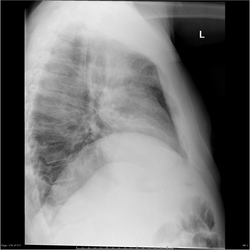 File:Q fever lateral - - Case courtesy of Royal Melbourne Hospital Respiratory, Radiopaedia.org, rID 21993.gif