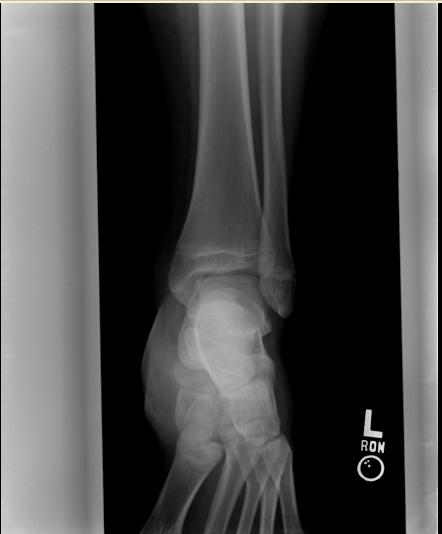 Salter-Harris fracture-III Image courtesy of RadsWiki and copylefted