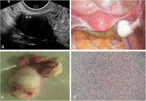 File:Ultrasound imaging of ovarian thecofibroma.jpg