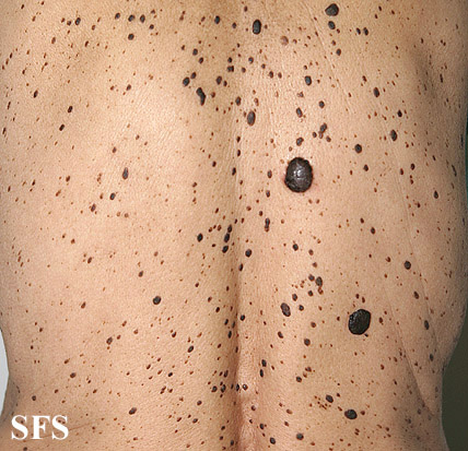 Keratosis seborrheic. Adapted from Dermatology Atlas.[12]
