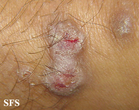 Prurigo nodularis. Adapted from Dermatology Atlas.[9]