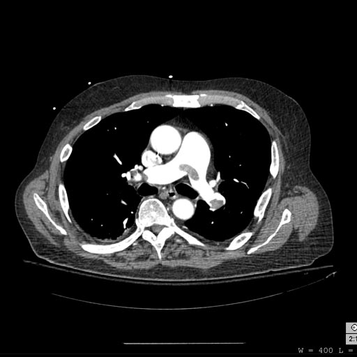 Pulmonary embolism: Patient presented with Shortness of breath