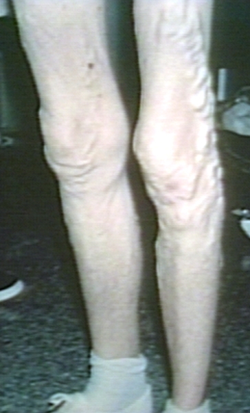 File:Varicose veins.jpg