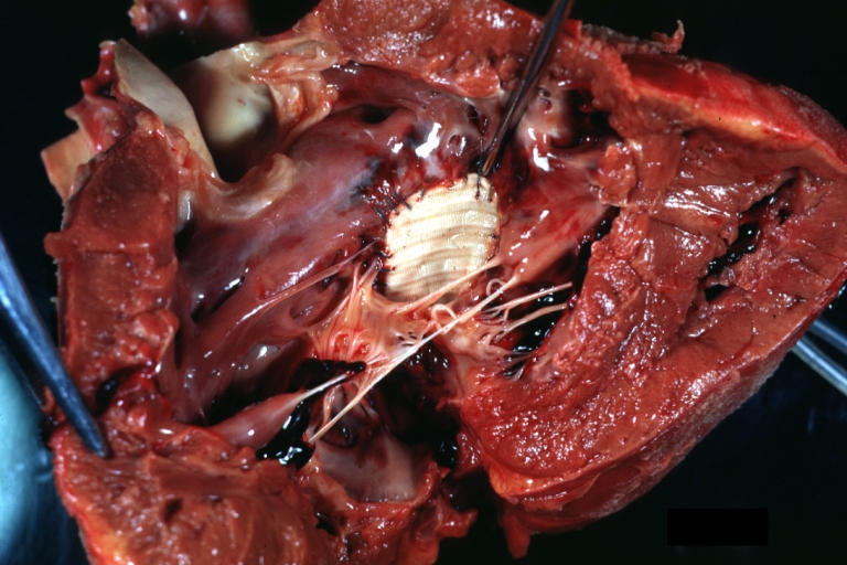 Interventricular Septal Defect (Perimembranous) with Patch Repair: Gross, natural color, view from right ventricle. A case of inverted ventricles