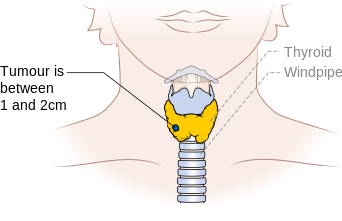 Stage T1b thyroid cancer
