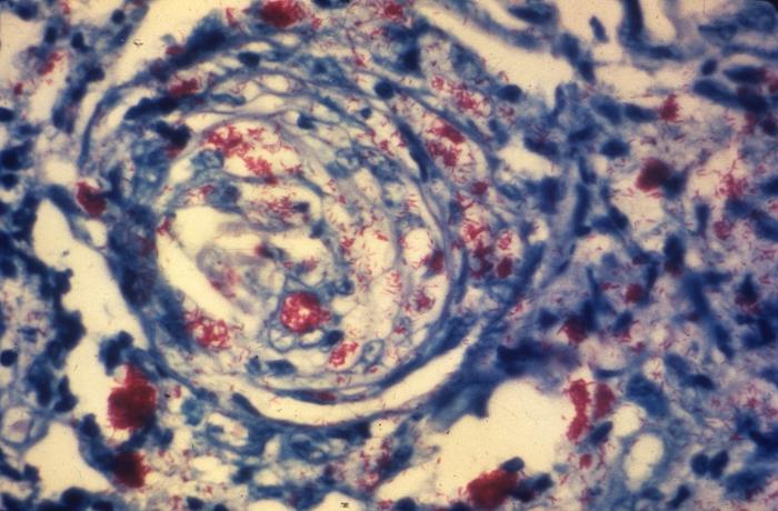 Photomicrograph of a skin tissue sample from patient with leprosy revealing cutaneous nerve, which had been invaded by numerous Mycobacterium leprae bacteria. Adapted from Public Health Image Library (PHIL), Centers for Disease Control and Prevention.[19]
