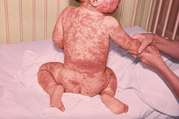 After having received a smallpox vaccination on the small of his back, a 14 month old infant manifested a non-specific rash in the form of extensive erythematous patches over his entire body, except for relative paring of the soles of his feet.Adapted from Public Health Image Library (PHIL), Centers for Disease Control and Prevention.[14]