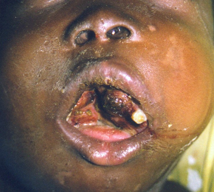 Picture of a mouth of a patient with Burkitt lymphoma showing disruption of teeth and partial obstruction of airway[8]