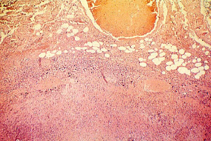 "Necrosis of lymph node due to anthrax”Adapted from Public Health Image Library (PHIL), Centers for Disease Control and Prevention.[20]