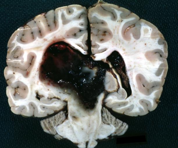 Brain: Glioma Thalamic Grade Ii-Iii: Gross; fixed tissue, coronal section, cerebral hemispheres with large hemorrhagic lesion