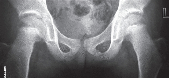 File:Progeria X-ray.gif
