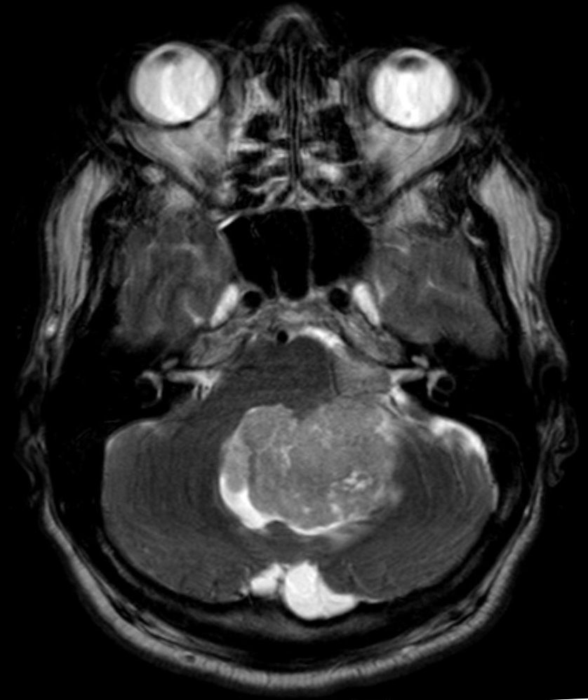 File:Ependymoma of 4th ventricle in MRI.jpg