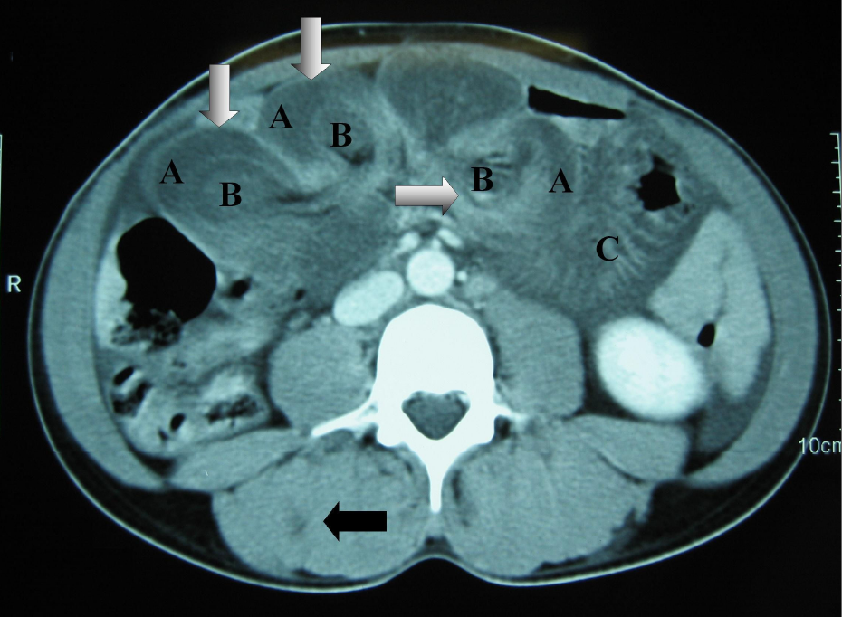 File:Multiple intestinal intussusceptions .png