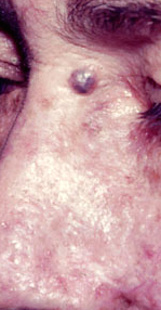 url = http://www.atlasdermatologico.com.br/disease.jsf?diseaseId=428>