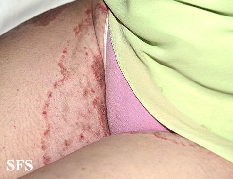 Tinea cruris. Adapted from Dermatology Atlas.[1]