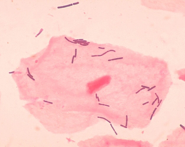 L. acidophilus bacteria near vaginal squamous epithelial cells)
