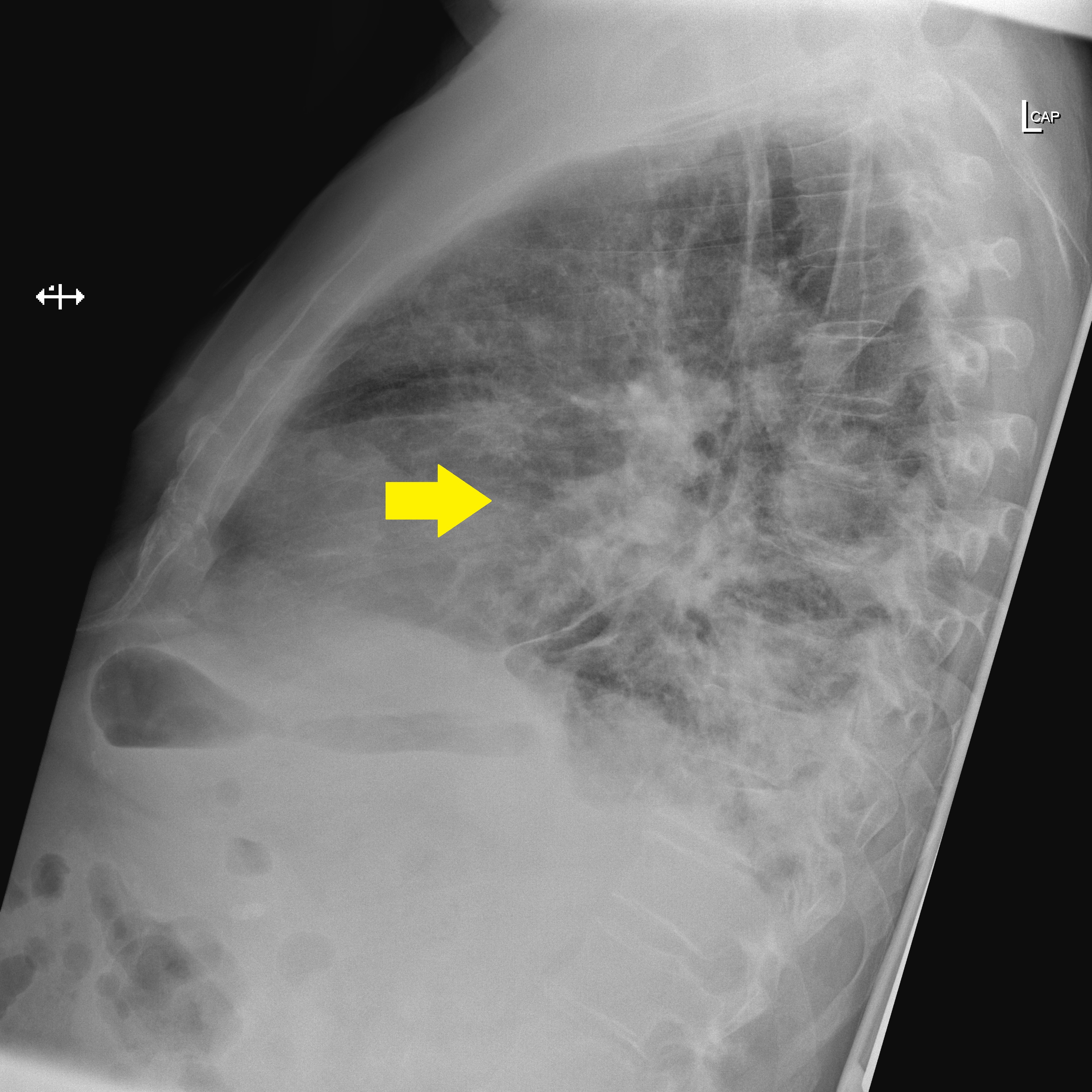 File:Nodular-pulmonary-amyloidosis-3 (1).jpg