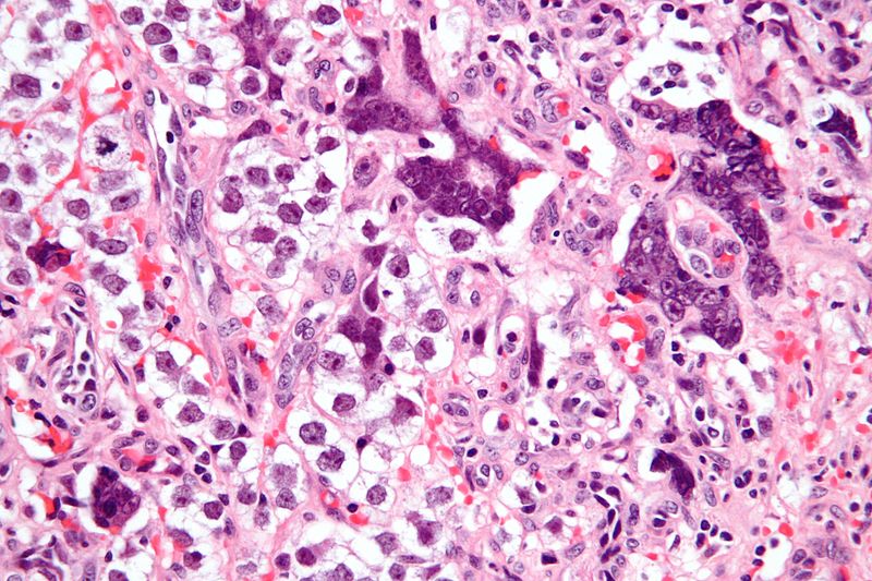 Very high magnification micrograph of a seminoma with syncytiotrophoblasts on H&E stain. Syncytiotrophoblasts are seen in approximately 10-20% of seminomas. They may be associated with an elevated serum beta-hCG.[2]
