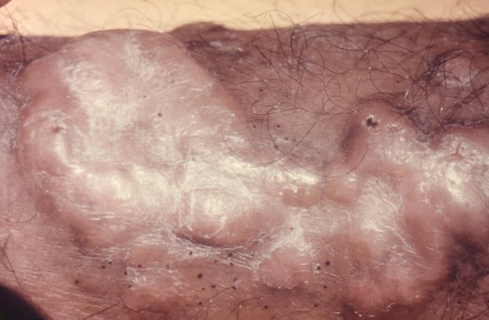 Patient’s right knee revealed the keloidal scarring brought on due to a case of cutaneous blastomycosis, caused by Blastomyces dermatitidis. From Public Health Image Library (PHIL). [1]