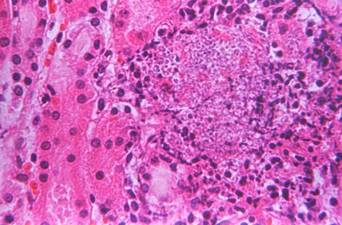 Histopathologic changes associated with a fungal infection, which had spread to this rabbit kidney tissue sample, due to the pathogen Candida albicans.(125x mag). From Public Health Image Library (PHIL). [9]