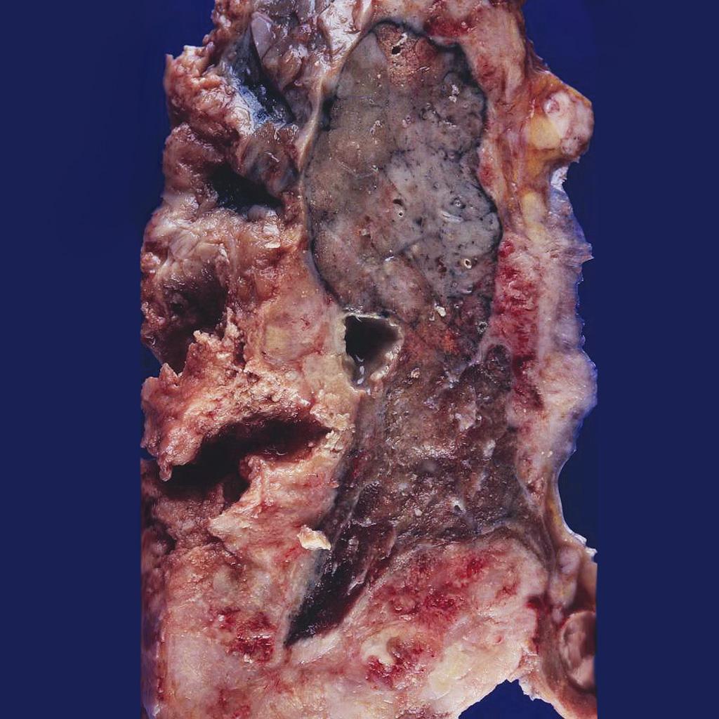 File:Mesothelioma gross pathology image 1.jpg