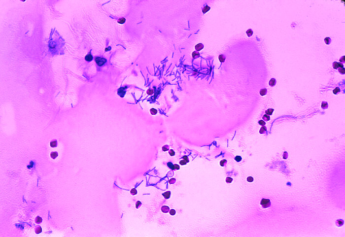 "Photomicrograph of serohemorrhagic meningitis in a case of fatal human anthrax with the presence ofBacillus anthracis.”Adapted from Public Health Image Library (PHIL), Centers for Disease Control and Prevention.[20]