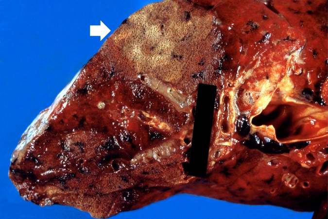 This is a gross photograph showing a closer view of a cut section of lung. An area of fibrosis (arrow) is evident in this photograph.