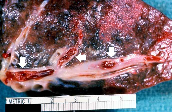 This is a gross photograph of a cut section of lung demonstrating thromboemboli in the pulmonary arteries (arrows).