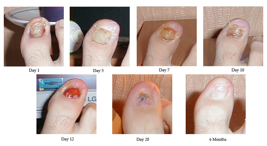 Toe healing process after nail removal.