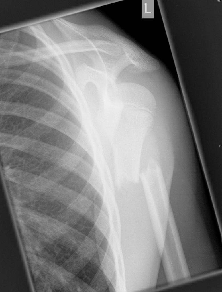 File:Proximal-humeral-fracture-in-child (1).jpg