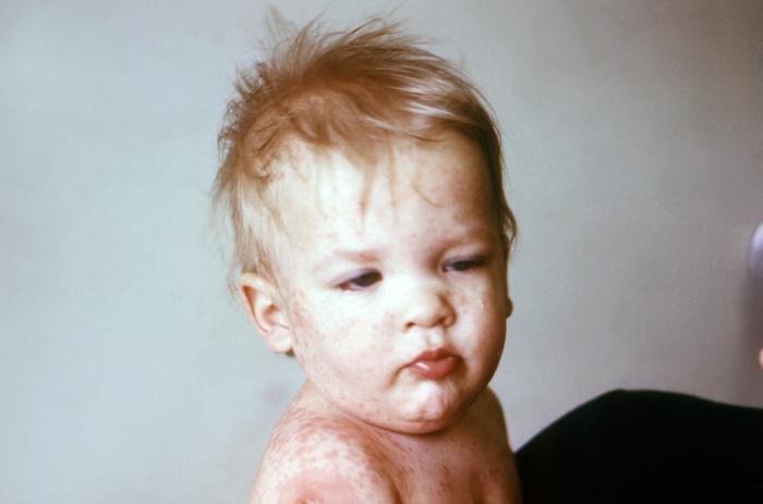 Face and upper torso of a young child after receiving a smallpox vaccination in the right shoulder region. Note the erythematous halo surrounding the vaccination site, and morbilliform skin rash, i.e., resembling measles (numerous flattened erythematous, amorphous macules)Adapted from Public Health Image Library (PHIL), Centers for Disease Control and Prevention.[3]