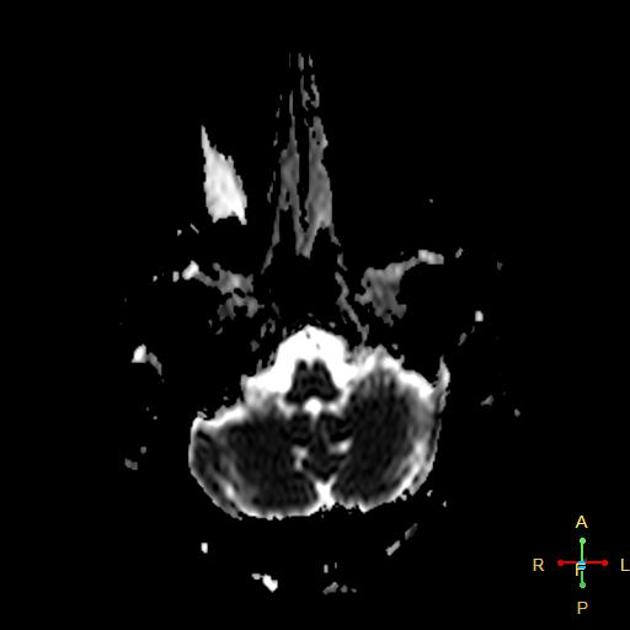 Axial ADC of gliomatosis cerebri.[3]