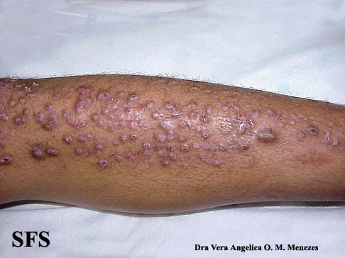 File:Epidermolysis bullosa pruriginosa11.jpg